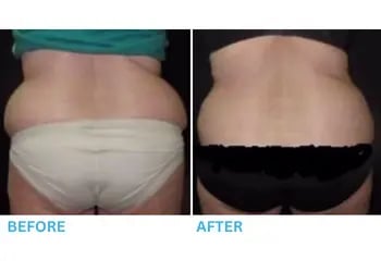 Al Nour Coolsculpting before and after