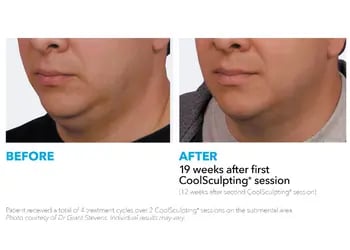 Coolsculpting before and after generic - chin