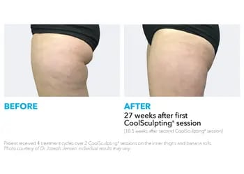 Coolsculpting before and after generic - thighs 2