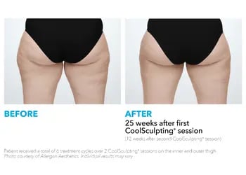 Coolsculpting before and after generic - thighs