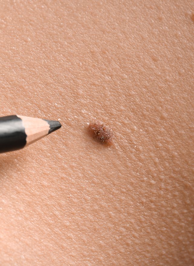 MoleRemovalBenefitsImage